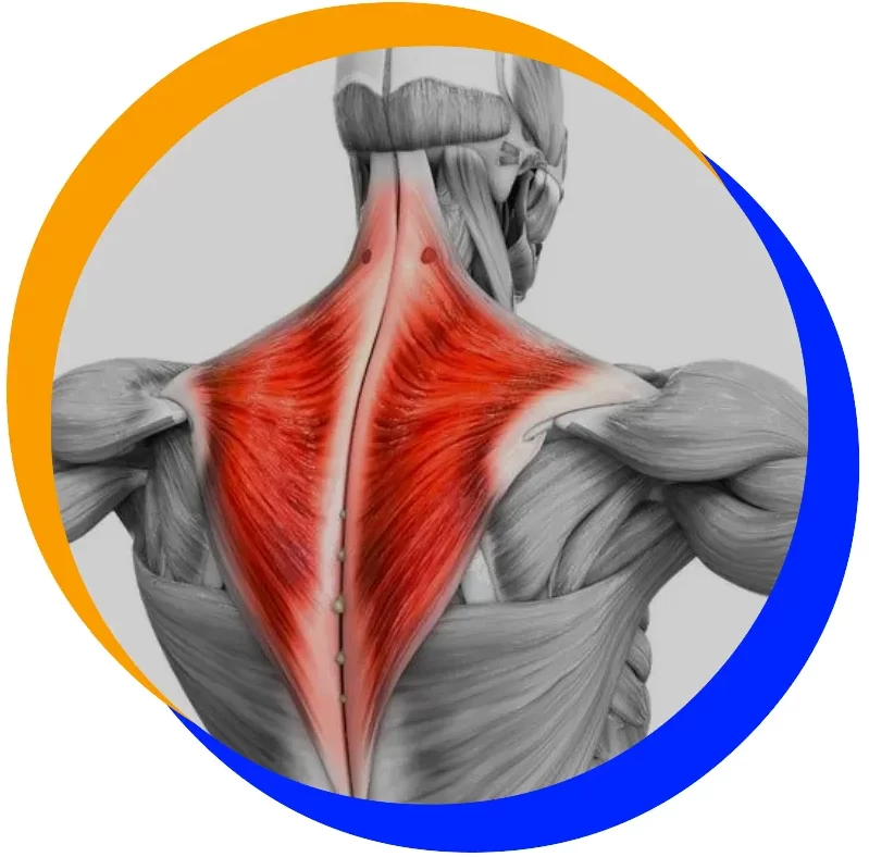 Pulled Trapezius Muscle